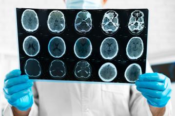 Study Shows Even Non-concussion Head Injuries Lead to Brain Changes