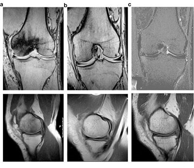 Discover the Benefits of Hyperbaric Health for Aseptic Bone Necrosis